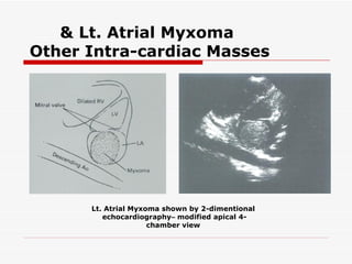 & Lt. Atrial Myxoma
Other Intra-cardiac Masses




      Lt. Atrial Myxoma shown by 2-dimentional
         echocardiography– modified apical 4-
                     chamber view
 