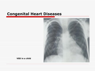 Congenital Heart Diseases




    VSD in a child
 