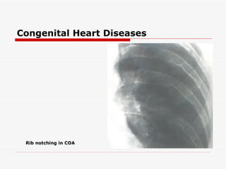 Congenital Heart Diseases




 Rib notching in COA
 