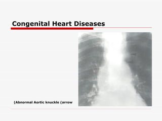 Congenital Heart Diseases




(Abnormal Aortic knuckle (arrow
 
