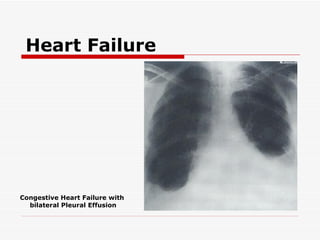 Heart Failure




Congestive Heart Failure with
  bilateral Pleural Effusion
 