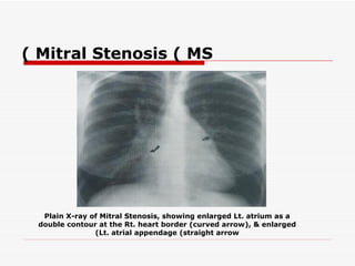 ( Mitral Stenosis ( MS




  Plain X-ray of Mitral Stenosis, showing enlarged Lt. atrium as a
 double contour at the Rt. heart border (curved arrow(, & enlarged
               (Lt. atrial appendage (straight arrow
 