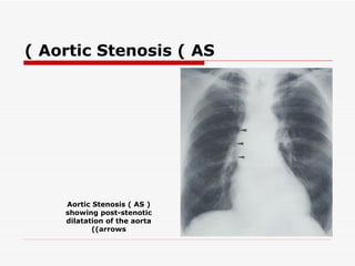 ( Aortic Stenosis ( AS




    Aortic Stenosis ( AS (
    showing post-stenotic
    dilatation of the aorta
           ((arrows
 