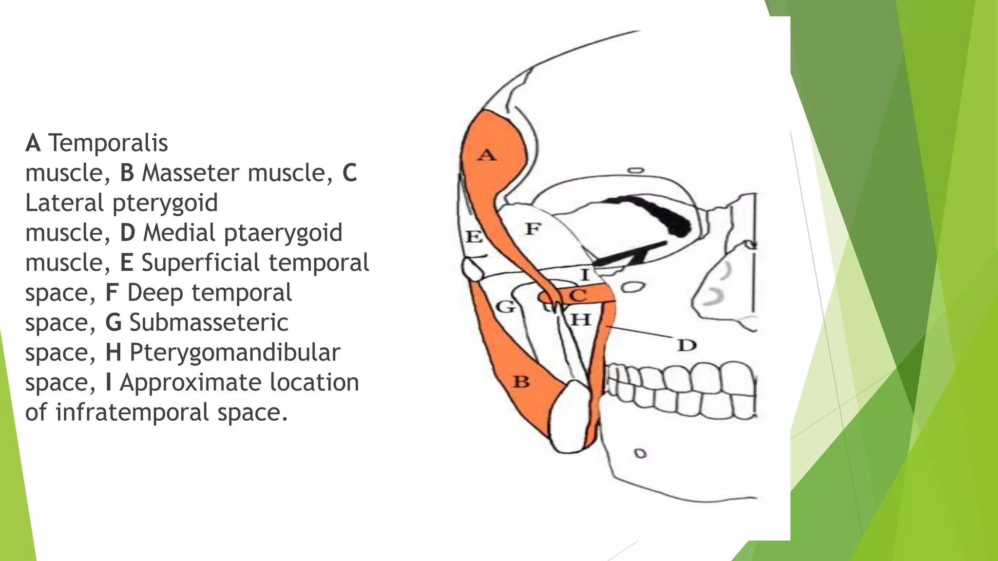 A Temporalis
muscle, B Masseter muscle, C
Lateral pterygoid
muscle, D Medial ptaerygoid
muscle, E Superficial temporal
space, F Deep temporal
space, G Submasseteric
space, H Pterygomandibular
space, I Approximate location
of infratemporal space.
 