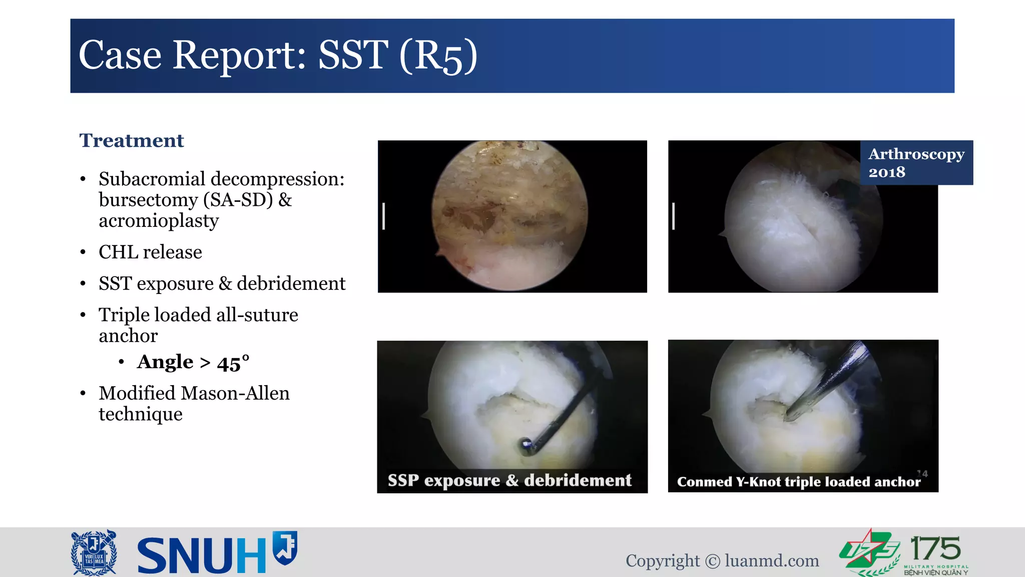 Modified Mason-Allen Technique For Rotator Cuff Repair | PDF