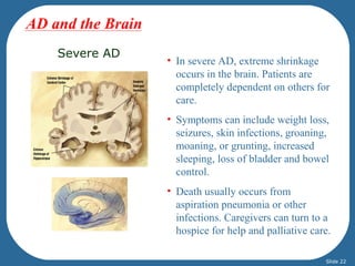 Severe AD 
• In severe AD, extreme shrinkage 
occurs in the brain. Patients are 
completely dependent on others for 
care. 
• Symptoms can include weight loss, 
seizures, skin infections, groaning, 
moaning, or grunting, increased 
sleeping, loss of bladder and bowel 
control. 
• Death usually occurs from 
aspiration pneumonia or other 
infections. Caregivers can turn to a 
hospice for help and palliative care. 
AD and the Brain 
Slide 22 
 
