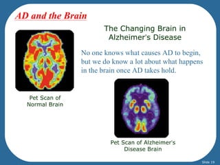 The Changing Brain in 
Alzheimer’s Disease 
No one knows what causes AD to begin, 
but we do know a lot about what happens 
in the brain once AD takes hold. 
Pet Scan of 
Normal Brain 
Pet Scan of Alzheimer’s 
Disease Brain 
AD and the Brain 
Slide 19 
 