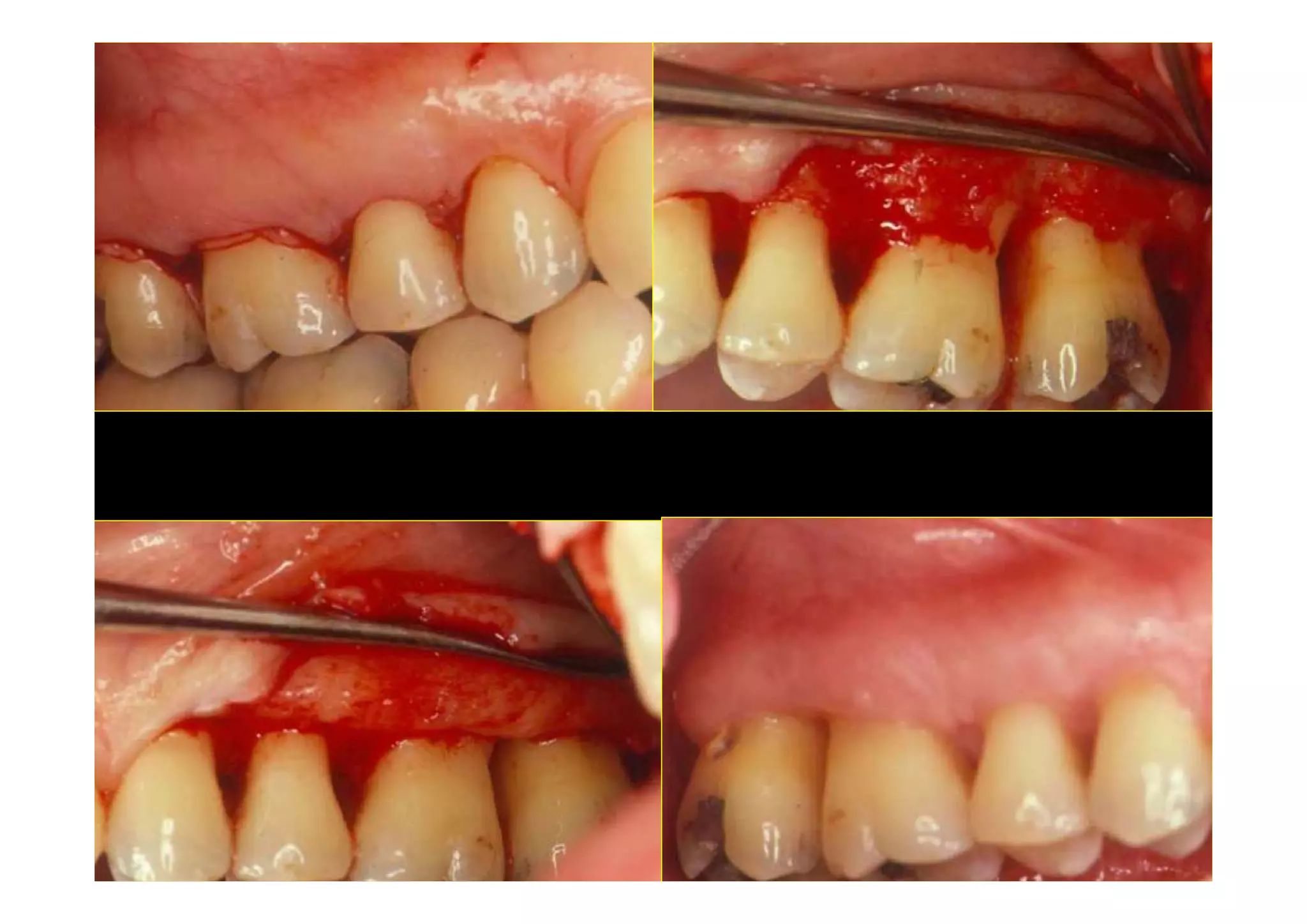 Modified widman flap PPT