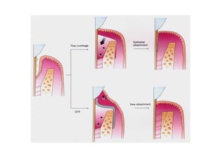 Modified widman flap