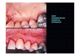 VERY
CONSERVATIVE
SURGICAL
APPROACH
 