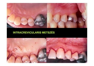 INTRACREVICULARIS METSZÉS
 