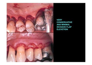 VERY
CONSERVATIVE
AND MINIMAL
INVASIVE FLAP
ELEVETION
 