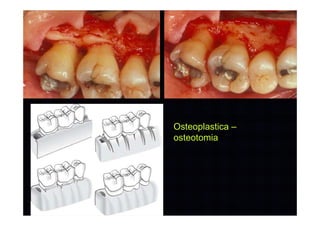 Osteoplastica –
osteotomia
 