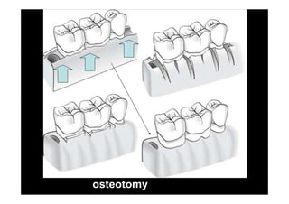osteotomy
 