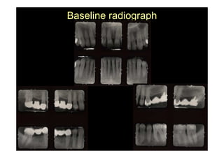 Baseline radiograph
 