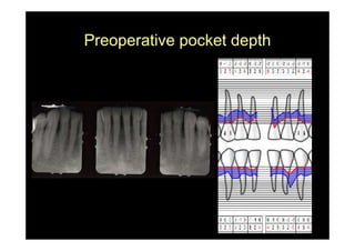 Preoperative pocket depth
 