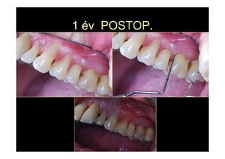 1 év POSTOP.
 