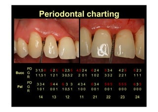Periodontal charting
12
6 3 3
1 0,5 1
6 2,5 5
3 0,5 2
11
4 3 4
1 0 0
4,5 2 4
2 0 1
242322211314
6 3 5
0 0 0
5 5 5
0 0 0
5 6 5
0 0 1
6 3 4
0 0 1
5 4 4
0 0 1
3 3 4
1 0 1
PD
G
R
Pal
5 2 3
1 1 1
4 2 5
2 2 1
5 3 4
3 3 2
6 2 4
1 0 2
6 2 5
1 2 1
3 1,5 6
1 1,5 1
PD
G
R
Bucc
 