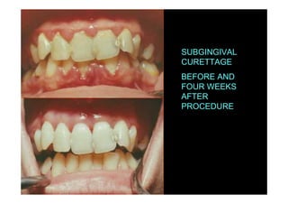 SUBGINGIVAL
CURETTAGE
BEFORE AND
FOUR WEEKS
AFTER
PROCEDURE
 