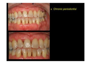 Chronic periodontisi
 