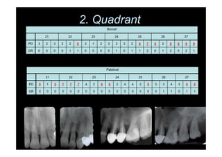 2. Quadrant
Buccal
21 22 23 24 25 26 27
PD 3 2 3 2 2 5 3 1 2 3 2 3 2 6 7 5 2 5 6 5 6
GR 0 0 0 0 1 1 0 0 0 0 1 0 1 1 2 0 1 2 0 2 1
Palatinal
21 22 23 24 25 26 27
PD 5 1 5 7 7 7 4 2 5 5 2 4 4 2 5 3 3 4 3 5 5
GR 0 0 0 0 0 0 0 0 0 0 0 0 0 0 0 0 1 1 0 1 1
 