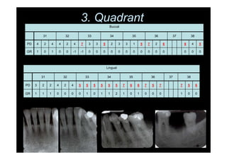 3. Quadrant
Buccal
31 32 33 34 35 36 37 38
PD 4 2 4 4 2 4 7 3 3 5 2 3 3 1 5 7 2 6 6 4 5
GR 1 0 1 0 0 -1 -1 0 0 0 0 0 0 0 0 0 0 0 0 0 0
Lingual
31 32 33 34 35 36 37 38
PD 3 2 2 4 2 4 5 5 5 5 5 5 7 6 6 7 5 7 7 5 6
GR 1 1 1 0 0 0 0 1 0 1 1 2 1 0 1 0 0 0 1 0 0
 