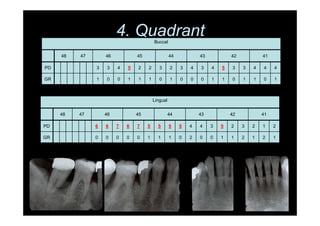 4. QuadrantBuccal
48 47 46 45 44 43 42 41
PD 3 3 4 5 2 2 3 2 3 4 3 4 5 3 3 4 4 4
GR 1 0 0 1 1 1 0 1 0 0 0 1 1 0 1 1 0 1
Lingual
48 47 46 45 44 43 42 41
PD 6 6 7 6 7 5 5 5 5 4 4 3 5 2 3 2 1 2
GR 0 0 0 0 0 1 1 1 0 2 0 0 1 1 2 1 2 1
 
