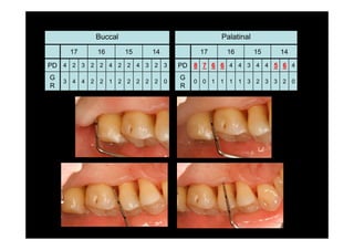 Buccal
17 16 15 14
PD 4 2 3 2 2 4 2 2 4 3 2 3
G
R
3 4 4 2 2 1 2 2 2 2 2 0
Palatinal
17 16 15 14
PD 8 7 6 6 4 4 3 4 4 5 6 4
G
R
0 0 1 1 1 1 3 2 3 3 2 0
 