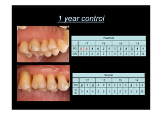 1 year control
Buccal
17 16 15 14
PD 4 3 4 4 2 3 3 2 3 3 3 3
G
R
3 4 4 2 2 1 2 2 2 2 2 0
Palatinal
17 16 15 14
PD 5 5 4 4 3 4 3 3 4 3 4 4
GR 2 2 2 2 2 1 3 3 3 4 2 0
 