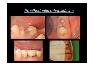 Prosthodontic rehabilitácion
 