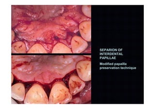 SEPARION OF
INTERDENTAL
PAPILLAE
Modified papailla
preservation technique
 