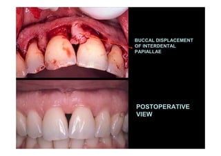 BUCCAL DISPLACEMENT
OF INTERDENTAL
PAPIALLAE
POSTOPERATIVE
VIEW
 