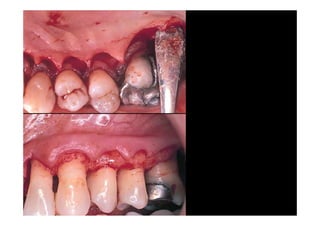 Modified widman flap