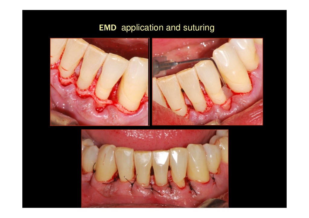 Modified widman flap