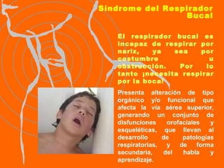 Síndrome del Respirador Bucal El respirador bucal es incapaz de respirar por nariz, ya sea por costumbre u obstrucción. Por lo tanto ¡necesita respirar por la boca! Presenta alteración de tipo orgánico y/o funcional que afecta la vía aérea superior, generando un conjunto de disfunciones orofaciales y esqueléticas, que llevan al desarrollo de patologías respiratorias, y de forma secundaria, del habla y aprendizaje.  