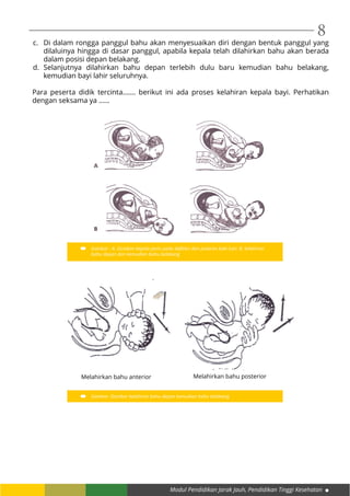 Modul Pendidikan Jarak Jauh, Pendidikan Tinggi Kesehatan
8
c.	 Di dalam rongga panggul bahu akan menyesuaikan diri dengan bentuk panggul yang
dilaluinya hingga di dasar panggul, apabila kepala telah dilahirkan bahu akan berada
dalam posisi depan belakang.
d.	Selanjutnya dilahirkan bahu depan terlebih dulu baru kemudian bahu belakang,
kemudian bayi lahir seluruhnya.
Para peserta didik tercinta....... berikut ini ada proses kelahiran kepala bayi. Perhatikan
dengan seksama ya ......
Gambar : A. Gerakan kepala janin pada defleksi dan putaran kaki luar; B. kelahiran
bahu depan dan kemudian bahu belakang
Gambar :Gambar kelahiran bahu depan kemudian bahu belakang
Melahirkan bahu anterior Melahirkan bahu posterior
 