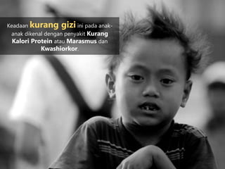 Keadaan kurang gizi ini pada anak-
anak dikenal dengan penyakit Kurang
Kalori Protein atau Marasmus dan
Kwashiorkor.
 