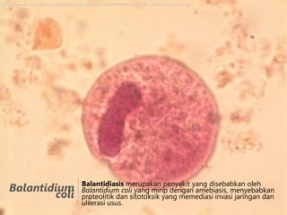 http://www.ym.edu.tw/par/image/parasite/Protozoa/Ciliophora/Balantidium/Balantidium_coli/Bal-col-CysFro2.jpg

Balantidium
coli

Balantidiasis merupakan penyakit yang disebabkan oleh
Balantidium coli yang mirip dengan amebiasis, menyebabkan
proteolitik dan sitotoksik yang memediasi invasi jaringan dan
ulserasi usus.

 