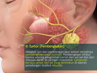 d. Tumor (Pembengkakan)
Masalah lain dari peradangan akut adalah terjadinya
pembengkaan lokal (tumor). Pembengkaan timbul
karena adanya pengiriman cairan dari sel-sel dan dari
sirkulasi darah ke jaringan interstitial. Campuran
berupa cairan dan sel yang tertimbun di daerah
peradangan disebut eksudat.
 