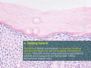 a. Radang Kataral
Terbentuk diatas permukaan membran mukosa
dimana terdapat sel-sel yang dapat mensekresi
musin. Eksudat musin yang paling banyak dikenal
adalah puck yang menyertai banyak infeksi
pernafasan bagian atas.
 