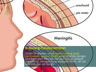 b. Radang Pseudomembran
Istilah ini dipakai untuk reaksi radang pada
permukaan selaput lendir yang ditandai dengan
pembentukan eksudat berupa lapisan selaput
superficial, mengandung endapan fibrin, sel-sel
nekrotik dan sel darah.
 