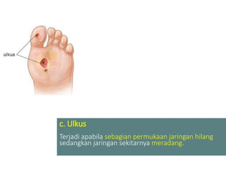 c. Ulkus
Terjadi apabila sebagian permukaan jaringan hilang
sedangkan jaringan sekitarnya meradang.
 
