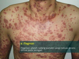 e. Flegmon
Flegmon adalah radang purulen yang meluas secara
difuse pada jaringan.
 