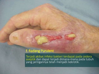 f. Radang Purulent
Terjadi akibat infeksi bakteri terdapat pada cedera
aseptik dan dapat terjadi dimana-mana pada tubuh
yang jaringannya telah menjadi nekrotik.
 