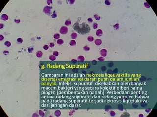 g. Radang Supuratif
Gambaran ini adalah nekrosis liqeuvaktifa yang
disertai emigrasi sel darah putih dalam jumlah
banyak. Infeksi supuratif disebabkan oleh banyak
macam bakteri yang secara kolektif diberi nama
piogen (pembentukan nanah). Perbedaan penting
antara radang supuratif dan radang purulen bahwa
pada radang supuratif terjadi nekrosis liquefaktiva
dari jaringan dasar.
 