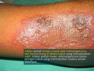 Infeksi adalah proses invasif oleh mikroorganisme
dan berkembang di dalam tubuh yang menyebabkan
sakit. Infeksi adalah invasi mikroorganisme dalam
jaringan tubuh yang menimbulkan cedera seluler
setempat.
 