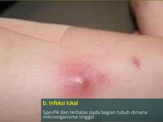 b. Infeksi lokal
Spesifik dan terbatas pada bagian tubuh dimana
mikroorganisme tinggal.
 