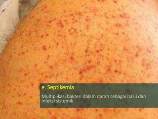 e. Septikemia
Multiplikasi bakteri dalam darah sebagai hasil dari
infeksi sistemik
 