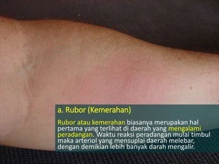 a. Rubor (Kemerahan)
Rubor atau kemerahan biasanya merupakan hal
pertama yang terlihat di daerah yang mengalami
peradangan. Waktu reaksi peradangan mulai timbul
maka arteriol yang mensuplai daerah melebar,
dengan demikian lebih banyak darah mengalir.
 