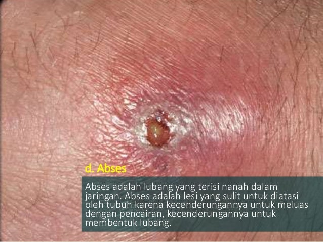 Radang dan mekanisme proses Infeksi Radang dan mekanisme proses Infeksi